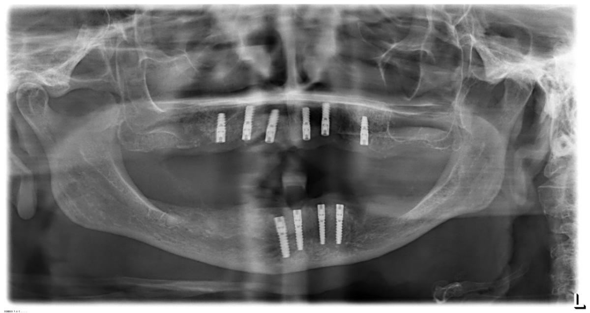 OPG po zavedení všech deseti implantátů BioniQ